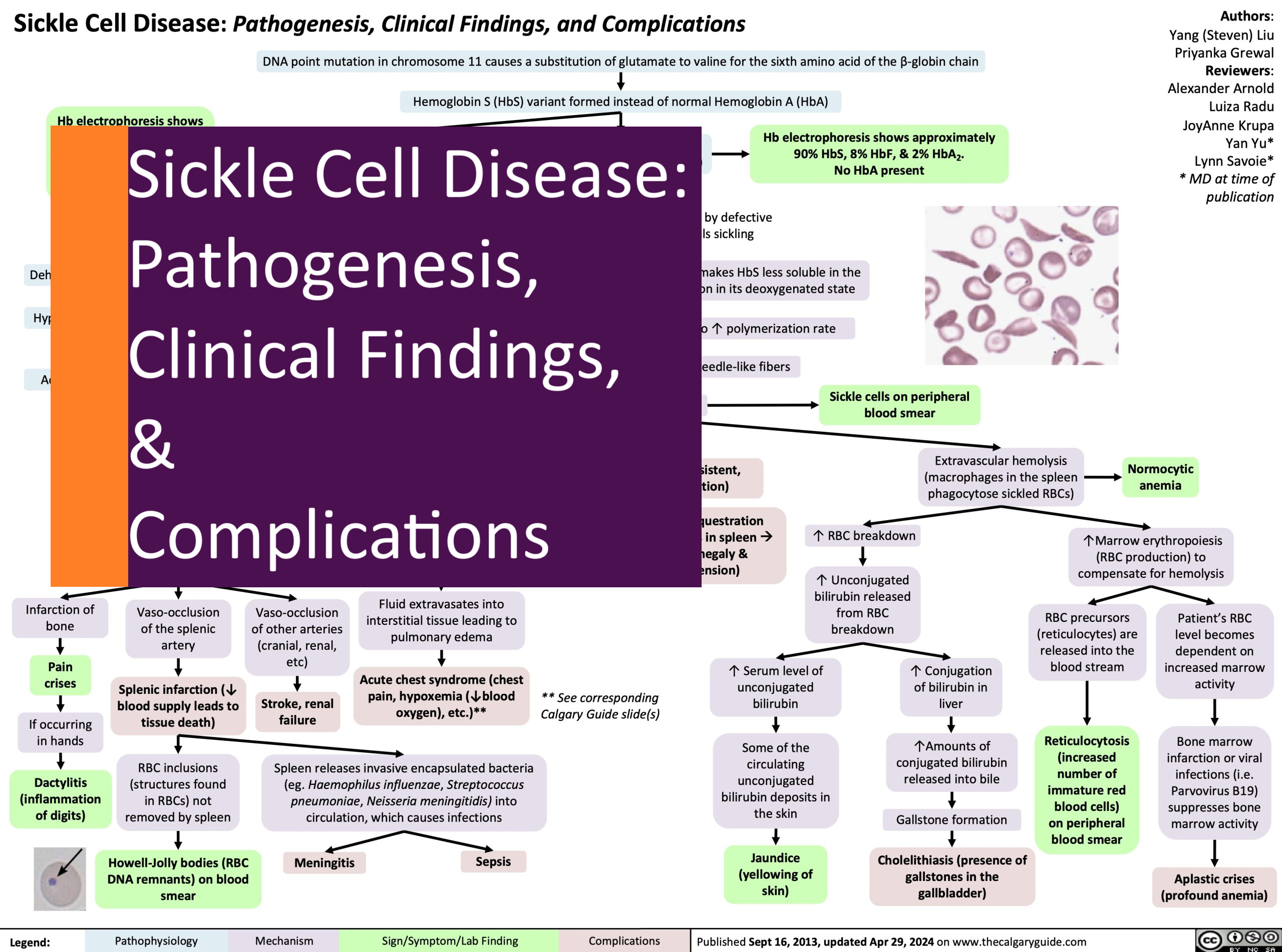The Calgary Guide to Understanding Disease. Sickle Cell Disease: Pathogenesis, Clinical Findings, and Complications. 2024.